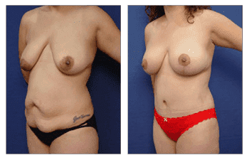 breast, lift, lee, expand, grover, surgery