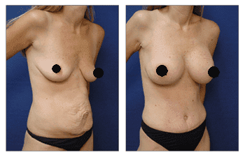 Best Tummy Tuck