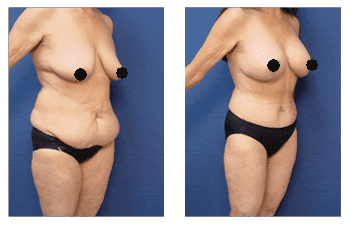 /06/medial-thigh-tuck2.png