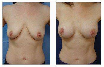 breast lift with implants patient 29 front view