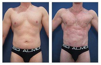 Tummy tuck with laser liposuction before and after.