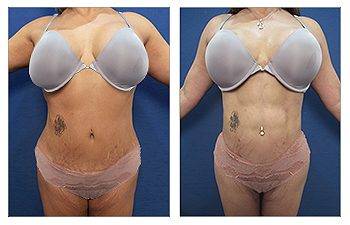 Tummy tuck with VASER lipo before and after.