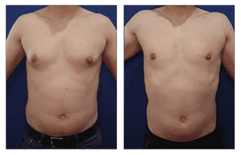 Gynecomastia