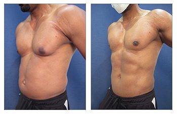 Experience the transformative effects of High Definition Abdominal Contouring with our remarkable before and after tummy tuck results.