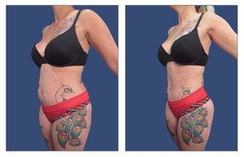 A woman undergoes liposuction and showcases her before and after tattoos.