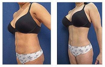 Mini tummy tuck before and after, muscle tightening.