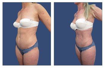 Mini tummy tuck before and after in Los Angeles.