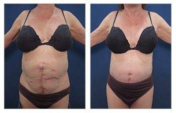 Tummy Tuck 4 (Abd Recon)