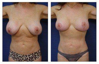 Breast Augmentation Surgery