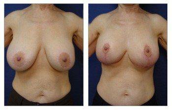 Breast Lift With Implant Augmentation To Decrease Areola Size, CPSI.