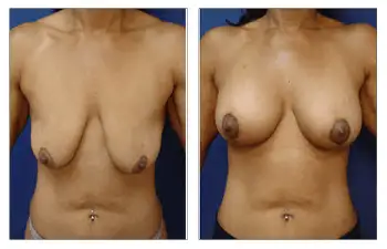 A woman's breasts before and after Breast Lift surgery.