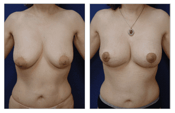 Breast Lift With Implant Augmentation Southern Orange County; CPSI