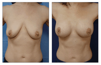 Breast Lift With Implant Augmentation Southern Los Angeles; CPSI.