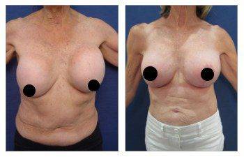 A woman's breast before and after surgery, showing the elimination of neck fullness.