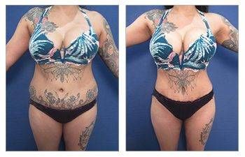 How Does VASER Melt the Fat?