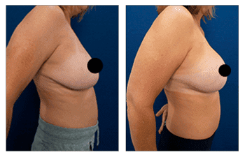 Breast Implant Augmentation After Breast Lift