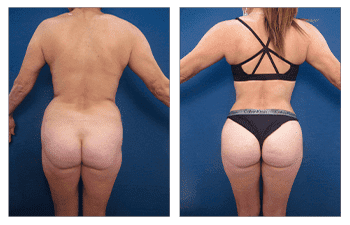 A woman's butt before and after tummy tuck surgery, emphasizing BBL transformation.