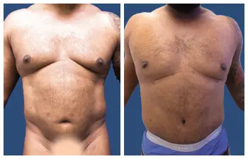 360 Tummy Tuck before and after.