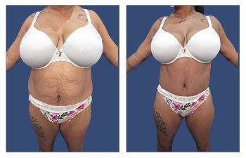 Plus size body contouring before and after tummy tuck.
