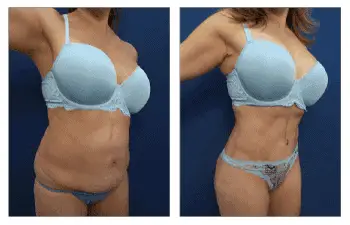 360 Tummy Tuck before and after.