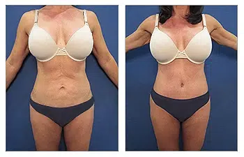Lipo Redo 3