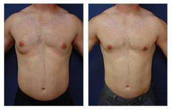 Does gynecomastia surgery reduce nipple size
