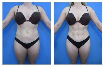Awake Liposuction