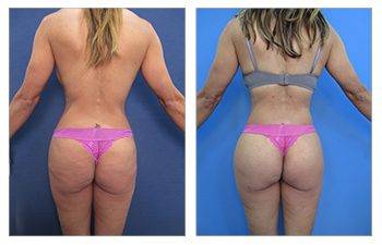 Increase in Brazilian Buttock Lifts in California