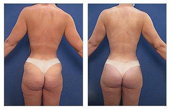 How to Correct Butt Cellulite