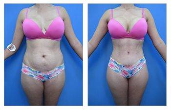 Liposuction with a Tummy Tuck