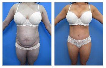 Liposuction with a Tummy Tuck