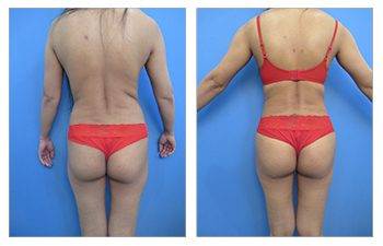 What Is The Skinny Brazilian Buttock Lift