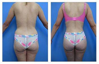 Brazilian Butt Lift Fat Emboli