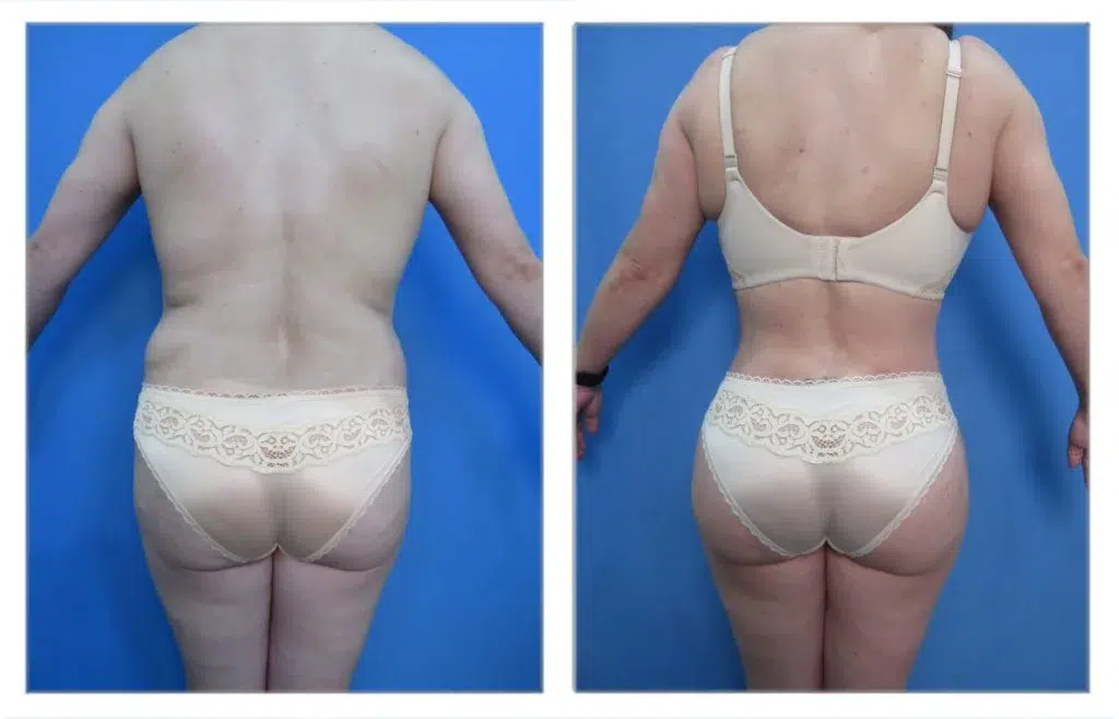 A woman wearing underwear and a BBL shape and size garment.