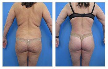 Tummy tuck to fix a sagging butt, with visible before and after results.