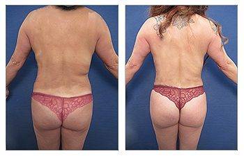 Tummy tuck and BBL surgery before and after.