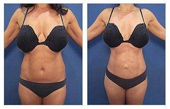 GMommy Breast Lift