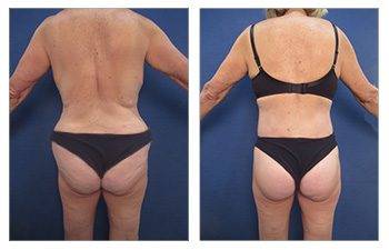 GMommy Lateral Thigh Tuck