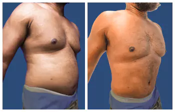 Liposuction Abdoominal Before and After