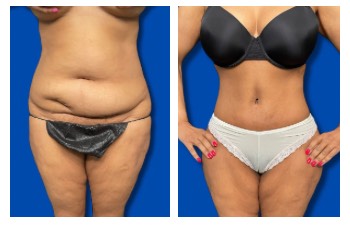 Awake Liposuction Near Me — before and after results
